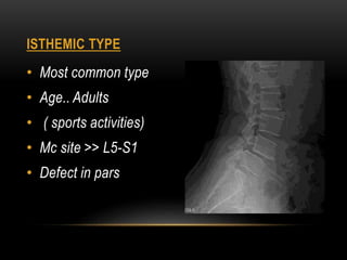 ISTHEMIC TYPE
• Most common type
• Age.. Adults
• ( sports activities)
• Mc site >> L5-S1
• Defect in pars
 