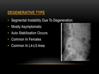 DEGENERATIVE TYPE
• Segmental Instability Due To Degeneration
• Mostly Asymptomatic
• Auto Stabilisation Occurs
• Common In Females
• Common In L4-L5 Area
 