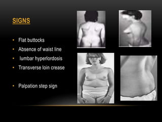 SIGNS
• Flat buttocks
• Absence of waist line
• lumbar hyperlordosis
• Transverse loin crease
• Palpation step sign
 