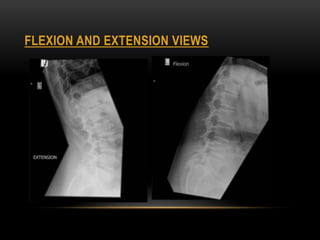 FLEXION AND EXTENSION VIEWS
 