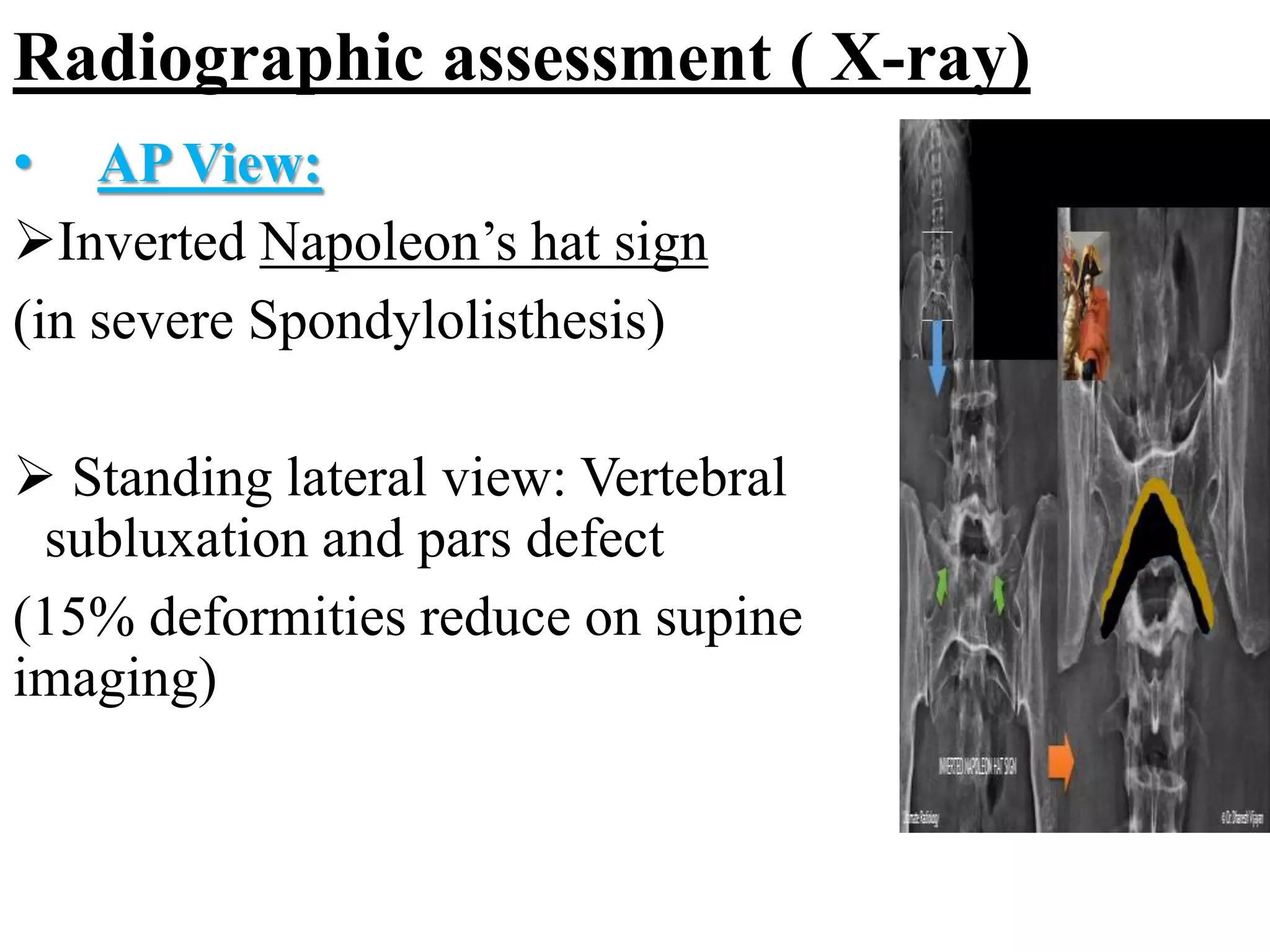 SPONDYLOLISTHESIS.ppt