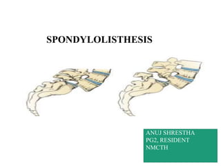 SPONDYLOLISTHESIS
ANUJ SHRESTHA
PG2, RESIDENT
NMCTH
 