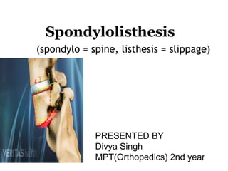 Spondylolisthesis
(spondylo = spine, listhesis = slippage)
PRESENTED BY
Divya Singh
MPT(Orthopedics) 2nd year
 