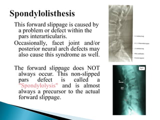 Slipped Forward Spondylolisthesis.ppt Spondylolisthesis is a spinal condition where one ...