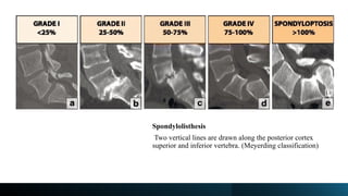 Spondylolisthesis
Two vertical lines are drawn along the posterior cortex
superior and inferior vertebra. (Meyerding classification)
 