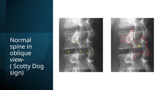 Normal
spine in
oblique
view-
( Scotty Dog
sign)
 