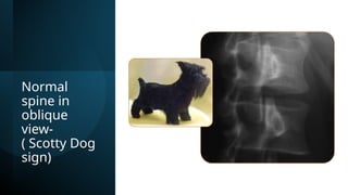 Normal
spine in
oblique
view-
( Scotty Dog
sign)
 
