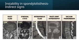 Instability in spondylolisthesis-
Indirect signs
 