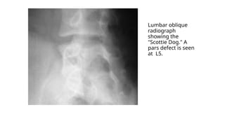 Lumbar oblique
radiograph
showing the
"Scottie Dog." A
pars defect is seen
at L5.
 