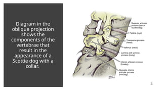 Diagram in the
oblique projection
shows the
components of the
vertebrae that
result in the
appearance of a
Scottie dog with a
collar.
 