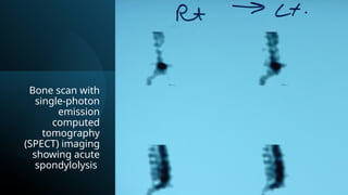 Bone scan with
single-photon
emission
computed
tomography
(SPECT) imaging
showing acute
spondylolysis
 