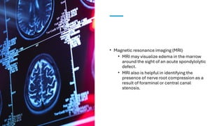• Magnetic resonance imaging (MRI)
• MRI may visualize edema in the marrow
around the sight of an acute spondylolytic
defect.
• MRI also is helpful in identifying the
presence of nerve root compression as a
result of foraminal or central canal
stenosis.
 