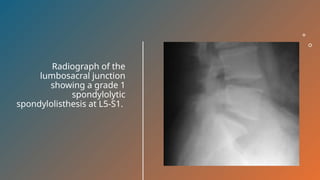 Radiograph of the
lumbosacral junction
showing a grade 1
spondylolytic
spondylolisthesis at L5-S1.
 