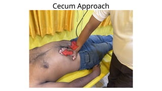 Cecum Approach
 