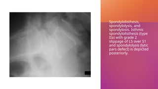 Spondylolisthesis,
spondylolysis, and
spondylosis. Isthmic
spondylolisthesis (type
IIa) with grade 2
slippage of L5 over S1
and spondylolysis (lytic
pars defect) is depicted
posteriorly.
 