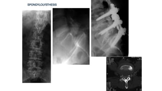 SPONDYLOLYSTHESIS
 