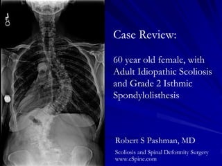 Case Review:
60 year old female, with
Adult Idiopathic Scoliosis
and Grade 2 Isthmic
Spondylolisthesis



Robert S Pashman, MD
Scoliosis and Spinal Deformity Surgery
www.eSpine.com
 