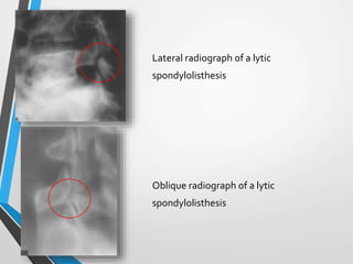 Lateral radiograph of a lytic
spondylolisthesis
Oblique radiograph of a lytic
spondylolisthesis
 