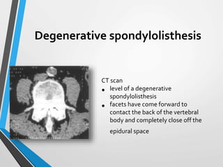 CT scan
• level of a degenerative
spondylolisthesis
• facets have come forward to
contact the back of the vertebral
body and completely close off the
epidural space
Degenerative spondylolisthesis
 