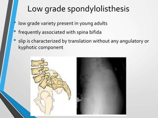 Low grade spondylolisthesis
• low grade variety present in young adults
• frequently associated with spina bifida
• slip is characterized by translation without any angulatory or
kyphotic component
 