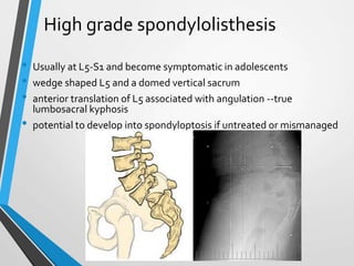 High grade spondylolisthesis
• Usually at L5-S1 and become symptomatic in adolescents
• wedge shaped L5 and a domed vertical sacrum
• anterior translation of L5 associated with angulation --true
lumbosacral kyphosis
• potential to develop into spondyloptosis if untreated or mismanaged
 