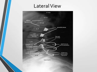 LateralView
 