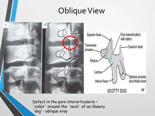 ObliqueView
Defect in the pars interarticularis –
‘collar’ around the ‘neck’ of an illusory
‘dog’- oblique xray
 