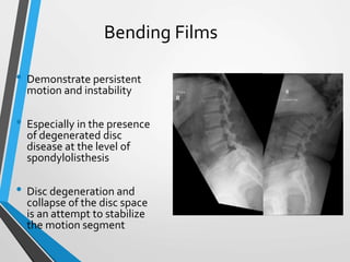 Bending Films
• Demonstrate persistent
motion and instability
• Especially in the presence
of degenerated disc
disease at the level of
spondylolisthesis
• Disc degeneration and
collapse of the disc space
is an attempt to stabilize
the motion segment
 