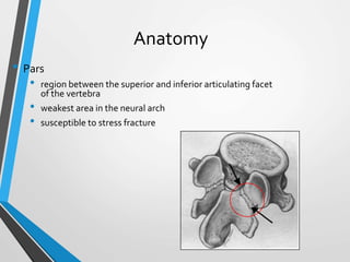 Anatomy
• Pars
• region between the superior and inferior articulating facet
of the vertebra
• weakest area in the neural arch
• susceptible to stress fracture
 