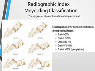Radiographic Index
Meyerding Classification
The degree of slips or transitional displacement
 