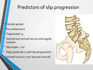 Predictors of slip progression
• Female gender
• Pre-pubescence
• Trapezoidal L5
• Domed and vertical sacrum and sagital
rotation
• Slip angle > -10o
• High grade slip (>50% slip progression)
• Inclined sacrum (>30o beyond vertical)
 