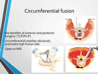 Circumferential fusion
• the benefits of anterior and posterior
surgery (TLIF/PLIF)
• circumferential stability obviously
promotes high fusion rate
• Open or MIS
 