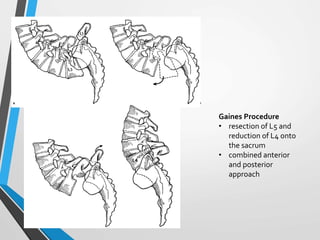 Gaines Procedure
• resection of L5 and
reduction of L4 onto
the sacrum
• combined anterior
and posterior
approach
 