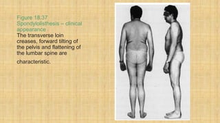 Figure 18.37
Spondylolisthesis – clinical
appearance
The transverse loin
creases, forward tilting of
the pelvis and flattening of
the lumbar spine are
characteristic.
 