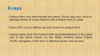 X-rays
• Oblique films may demonstrate the classic ‘Scotty dog neck’ which is
pathognomonic of a pars fracture with a broken neck or collar.
• About 20% of pars defects are only shown on oblique films.
• Lateral views show the forward shift (spondylolisthesis) of the upper
part of the spinal column on the stable vertebra below (Figure
18.38); elongation of the arch or defective facets may be seen.
 