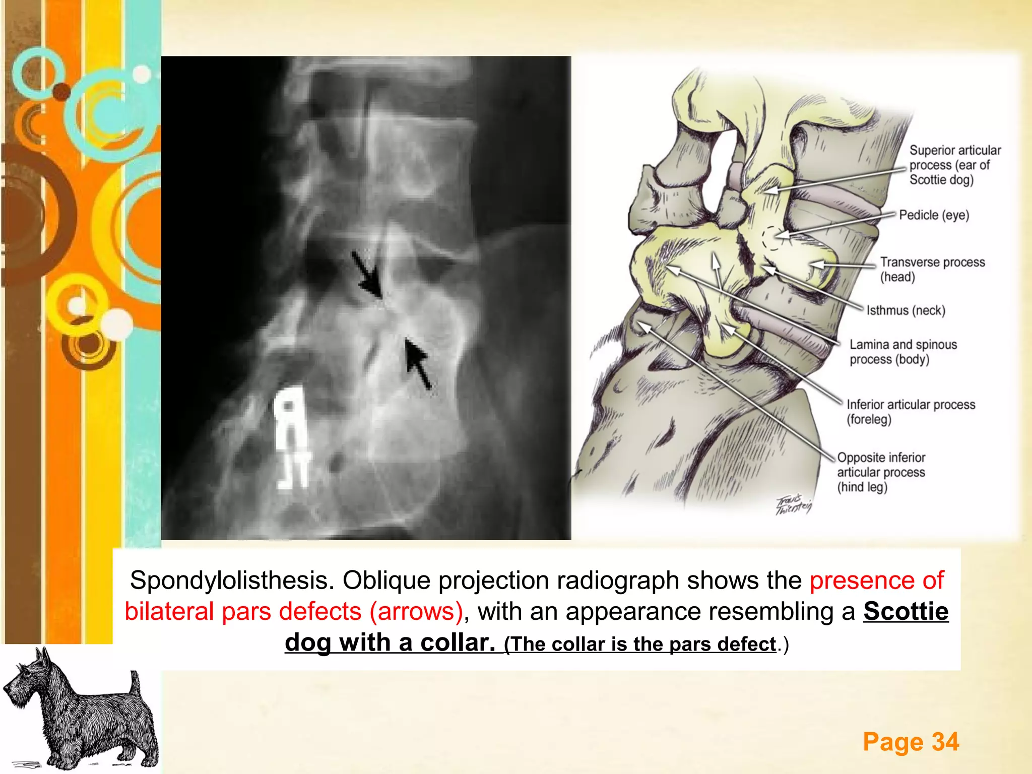 Spondylolisthesis. Oblique projection radiograph shows the presence of
bilateral pars defects (arrows), with an appearance resembling a Scottie
dog with a collar. (The collar is the pars defect.)
Free Powerpoint Templates

Page 34

 