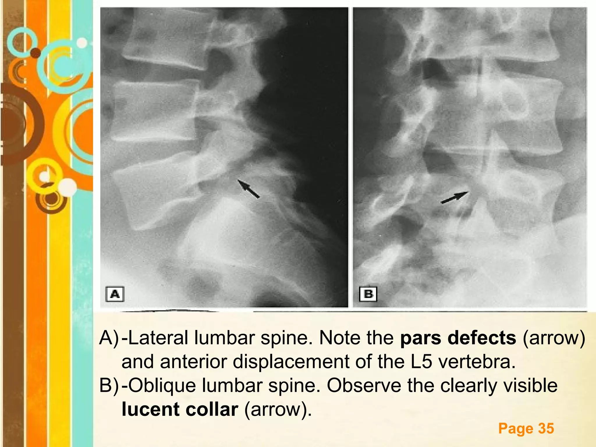 A) -Lateral lumbar spine. Note the pars defects (arrow)
and anterior displacement of the L5 vertebra.
B) -Oblique lumbar spine. Observe the clearly visible
lucent collar (arrow). Templates
Free Powerpoint
Page 35

 