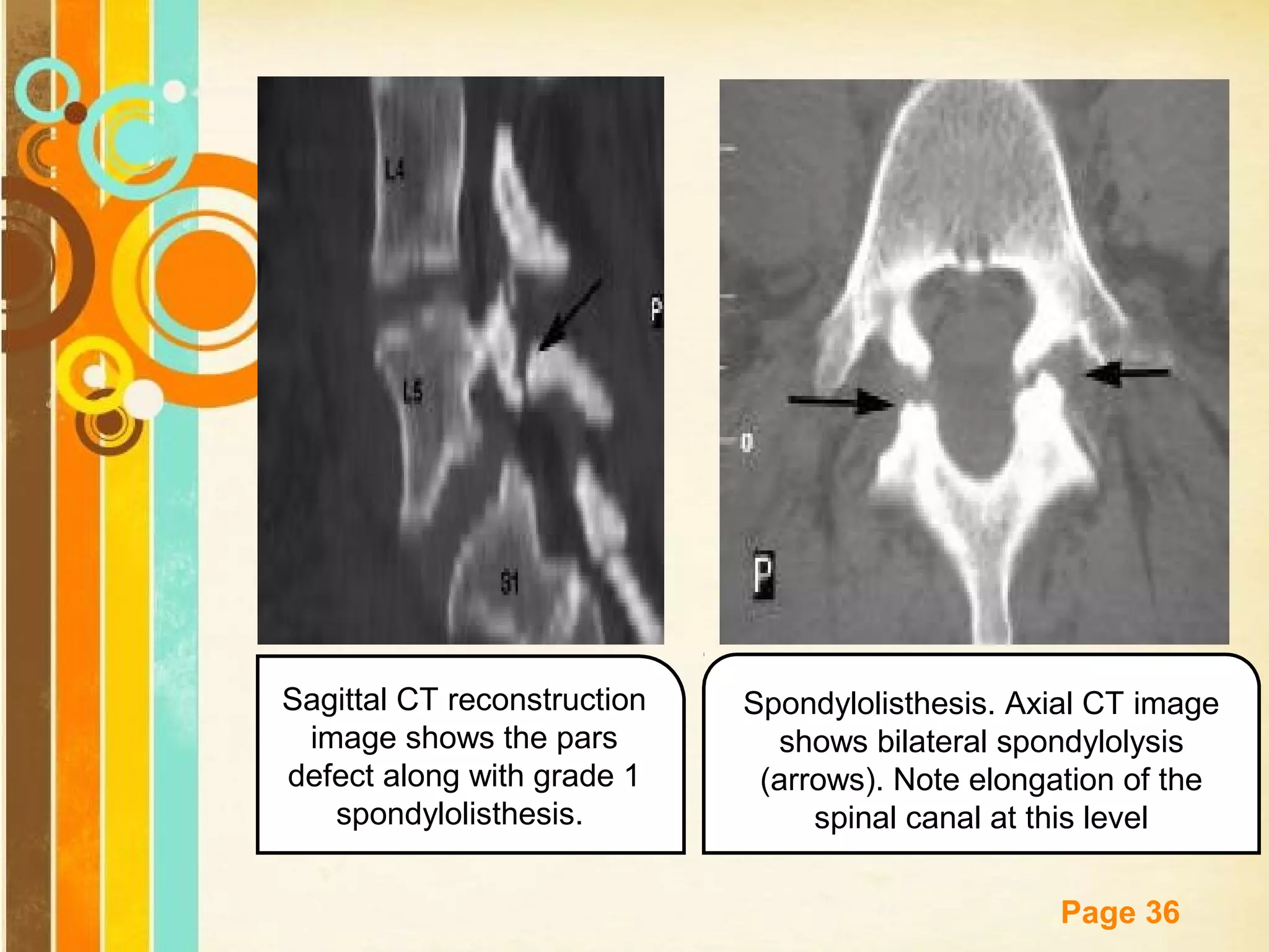 Sagittal CT reconstruction
image shows the pars
defect along with grade 1
spondylolisthesis.

Spondylolisthesis. Axial CT image
shows bilateral spondylolysis
(arrows). Note elongation of the
spinal canal at this level

Free Powerpoint Templates

Page 36

 