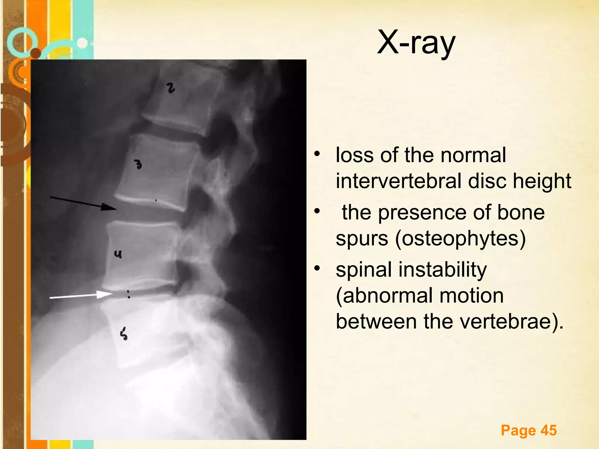 X-ray
• loss of the normal
intervertebral disc height
• the presence of bone
spurs (osteophytes)
• spinal instability
(abnormal motion
between the vertebrae).

Free Powerpoint Templates

Page 45

 