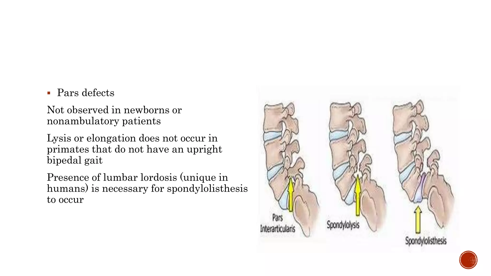 Pars Defect Cartoon Spondylolisthesis in adults and children | PPTX