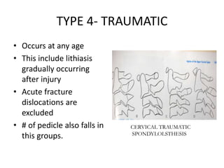 TYPE 4- TRAUMATIC
• Occurs at any age
• This include lithiasis
gradually occurring
after injury
• Acute fracture
dislocations are
excluded
• # of pedicle also falls in
this groups.
CERVICAL TRAUMATIC
SPONDYLOLSTHESIS
 