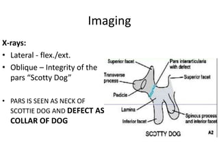 Imaging
X-rays:
• Lateral - flex./ext.
• Oblique – Integrity of the
pars “Scotty Dog”
• PARS IS SEEN AS NECK OF
SCOTTIE DOG AND DEFECT AS
COLLAR OF DOG
 