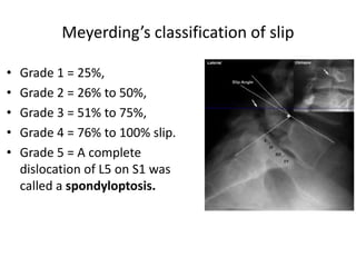 Meyerding’s classification of slip
• Grade 1 = 25%,
• Grade 2 = 26% to 50%,
• Grade 3 = 51% to 75%,
• Grade 4 = 76% to 100% slip.
• Grade 5 = A complete
dislocation of L5 on S1 was
called a spondyloptosis.
 
