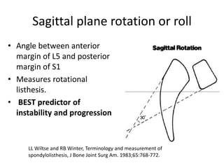 Sagittal plane rotation or roll
• Angle between anterior
margin of L5 and posterior
margin of S1
• Measures rotational
listhesis.
• BEST predictor of
instability and progression
LL Wiltse and RB Winter, Terminology and measurement of
spondylolisthesis, J Bone Joint Surg Am. 1983;65:768-772.
 