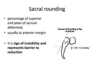 Sacral rounding
• percentage of superior
end plate of sacrum
deformed,
• usually at anterior margin
• It is sign of instability and
represents barrier to
reduction
 