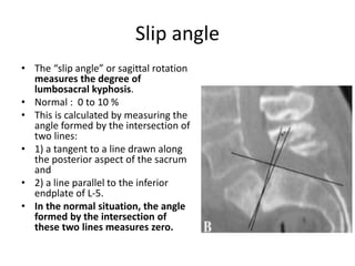 Slip angle
• The “slip angle” or sagittal rotation
measures the degree of
lumbosacral kyphosis.
• Normal : 0 to 10 %
• This is calculated by measuring the
angle formed by the intersection of
two lines:
• 1) a tangent to a line drawn along
the posterior aspect of the sacrum
and
• 2) a line parallel to the inferior
endplate of L-5.
• In the normal situation, the angle
formed by the intersection of
these two lines measures zero.
 