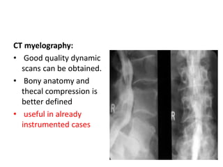 CT myelography:
• Good quality dynamic
scans can be obtained.
• Bony anatomy and
thecal compression is
better defined
• useful in already
instrumented cases
 