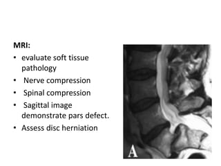 MRI:
• evaluate soft tissue
pathology
• Nerve compression
• Spinal compression
• Sagittal image
demonstrate pars defect.
• Assess disc herniation
 