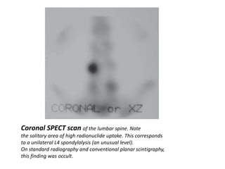 Coronal SPECT scan of the lumbar spine. Note
the solitary area of high radionuclide uptake. This corresponds
to a unilateral L4 spondylolysis (an unusual level).
On standard radiography and conventional planar scintigraphy,
this finding was occult.
 