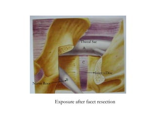 Nerve Root
Inter v.Disc
Thecal Sac
Exposure after facet resection
 